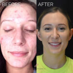 Microneedling with PRP before and after photo