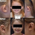 Otoplasty (ear pinning surgery) before and after photo