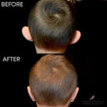 Otoplasty (ear pinning surgery) before and after photo