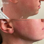 Rhinoplasty before and after photo