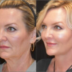 plastic surgery before and after photo
