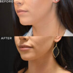 Dermal Filler before and after photo