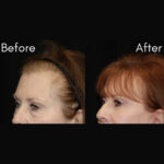Blepharoplasty before and after photo