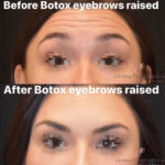 Botox before and after photo