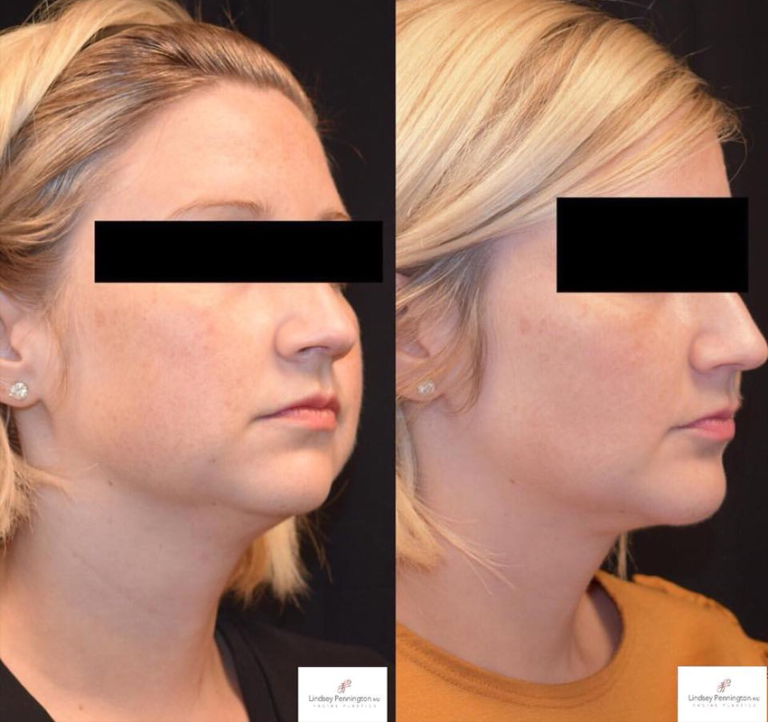 Buccal Fat Removal before and after photo