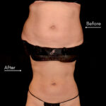 Coolsculpting before and after photo