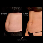 Coolsculpting before and after photo