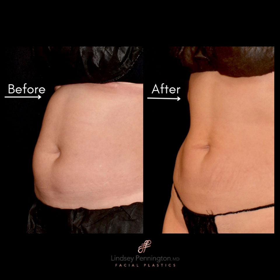 Coolsculpting before and after photo