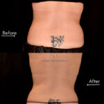 Coolsculpting before and after photo