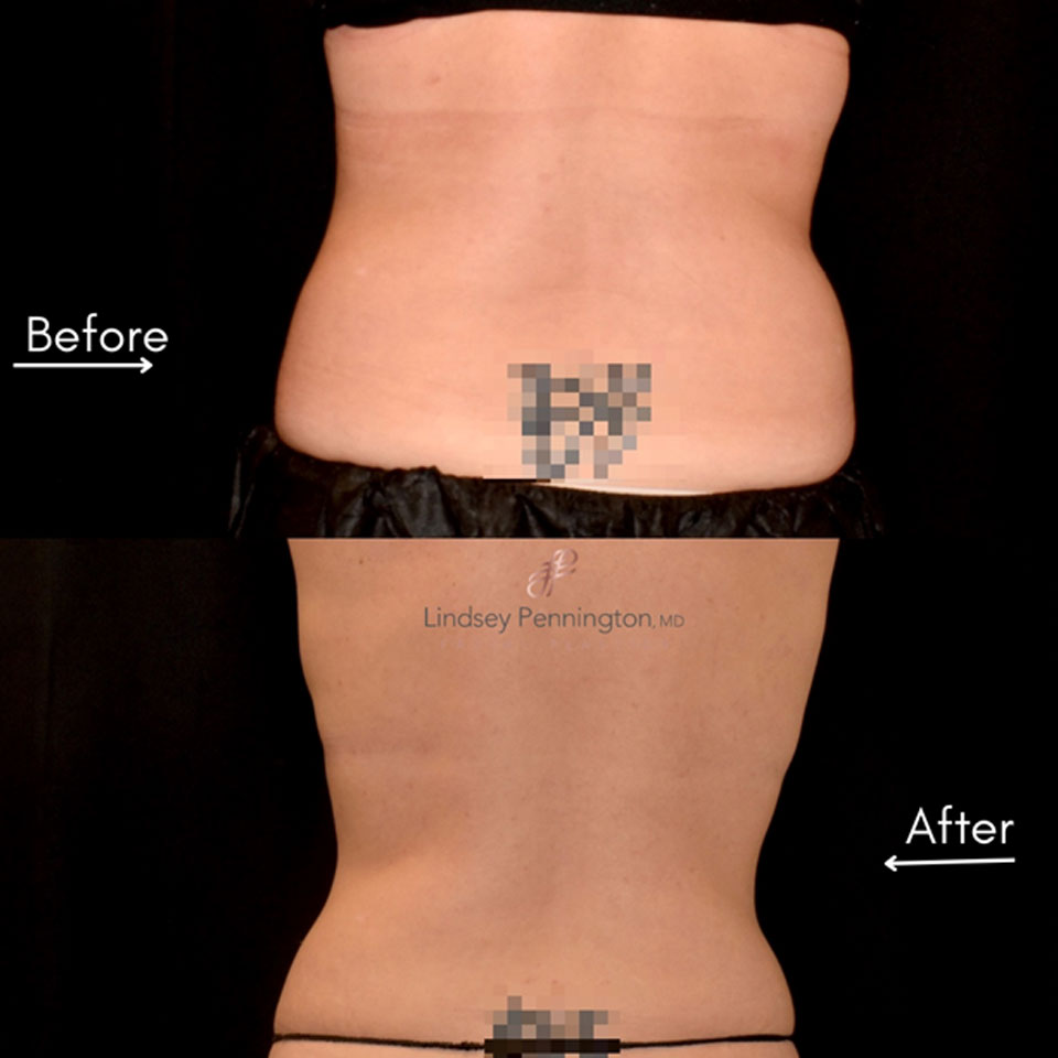 Coolsculpting before and after photo