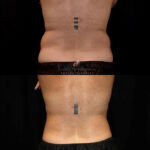 Coolsculpting before and after photo