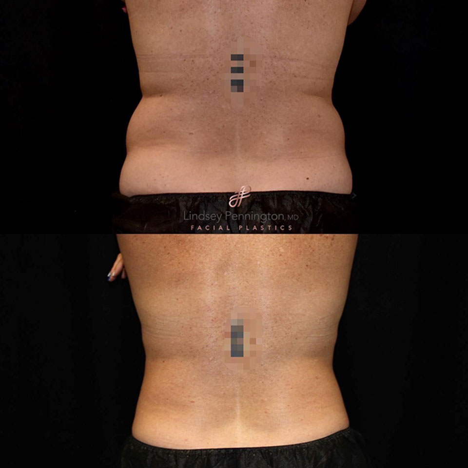 Coolsculpting before and after photo