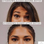 Eyebrow lift before and after photo
