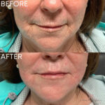 Dermal Filler before and after photo