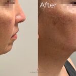 Dermal Filler before and after photo