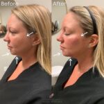 Dermal Filler before and after photo