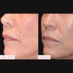 Dermal Filler before and after photo