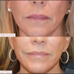 Dermal Filler before and after photo