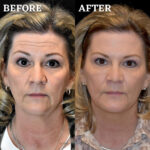 Dermal Filler before and after photo