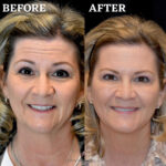 Dermal Filler before and after photo