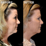 Dermal Filler before and after photo