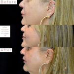 Dermal Filler before and after photo