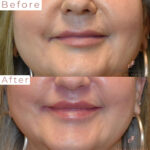 Dermal Filler before and after photo