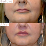 Dermal Filler before and after photo