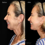 Facelift before and after photo