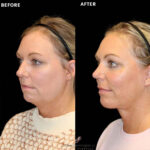 Facelift before and after photo