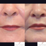 Lip Lift before and after photo