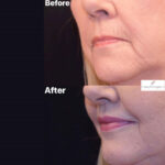 Lip Lift before and after photo