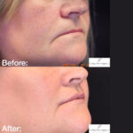 Lip Lift before and after photo