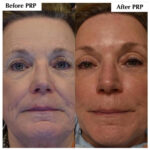 Microneedling with PRP before and after photo