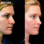 Rhinoplasty before and after photo