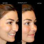Rhinoplasty before and after photo