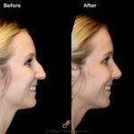 Rhinoplasty before and after photo