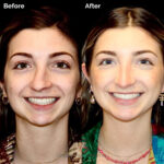 Rhinoplasty before and after photo