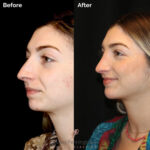 Rhinoplasty before and after photo