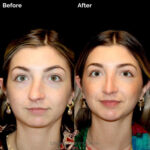 Rhinoplasty before and after photo