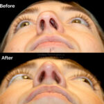 Rhinoplasty before and after photo