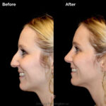 Rhinoplasty before and after photo