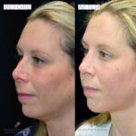 Rhinoplasty before and after photo