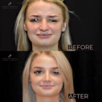Rhinoplasty before and after photo