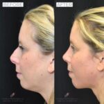 Rhinoplasty before and after photo