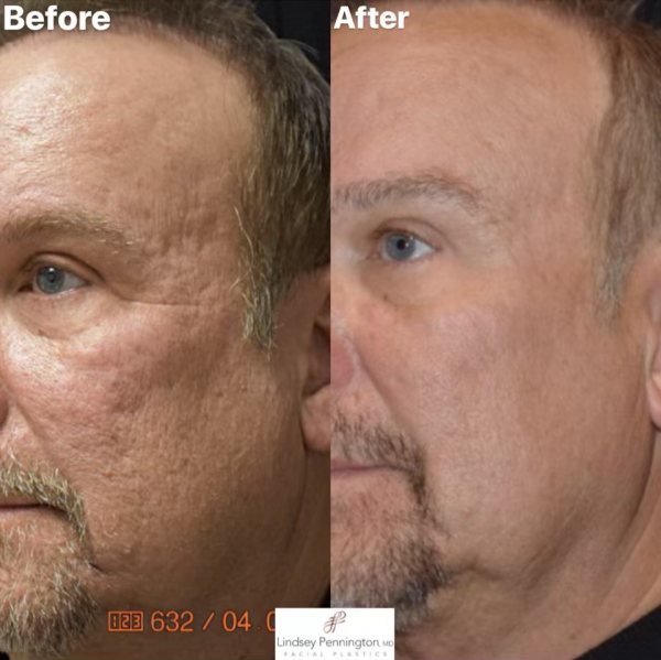 Microneedling with RF and PRP before and after photo