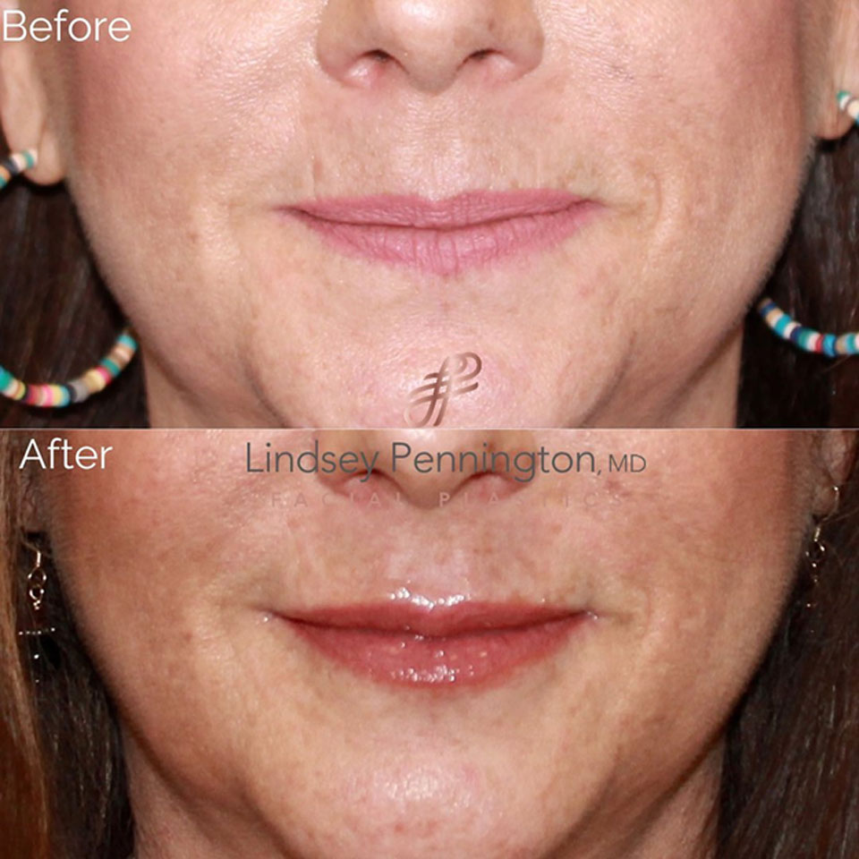 Dermal Filler before and after photo
