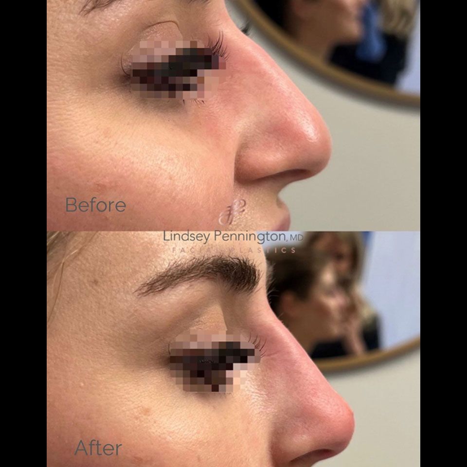 Dermal Filler before and after photo