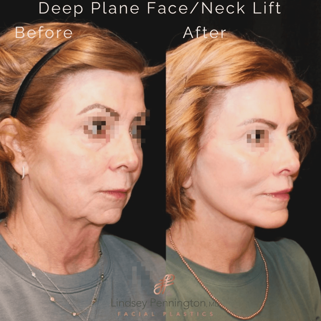 Facelift patient three quarter view right