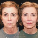 facelift patient front view